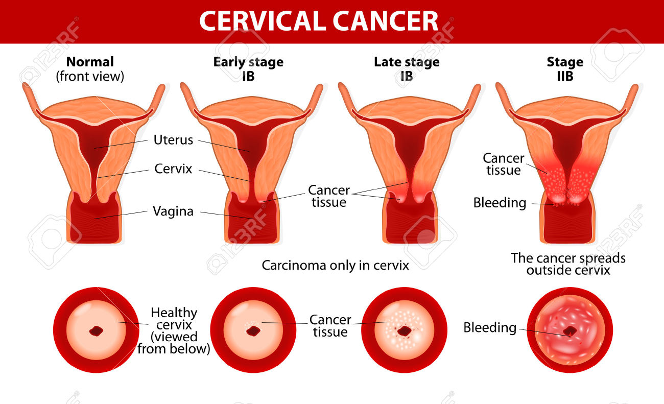 24525481-Cervical-Cancer-Carcinoma-della-Cervice-Tumore-maligno-che-origina-dalle-cellule-del-collo-dell-uter-Archivio-Fotografico